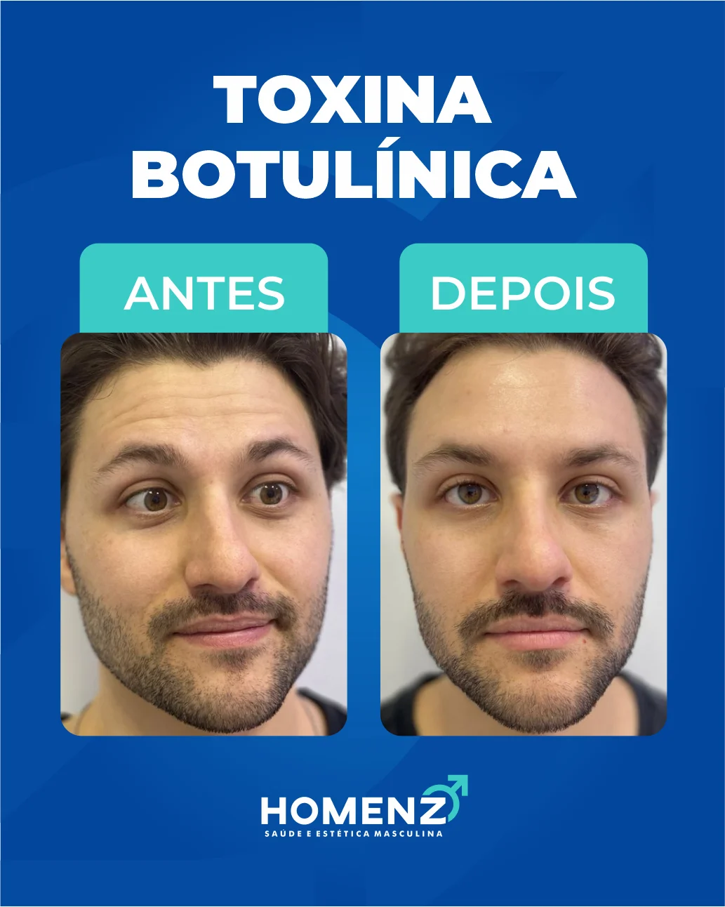 Antes e depois tratamento facial