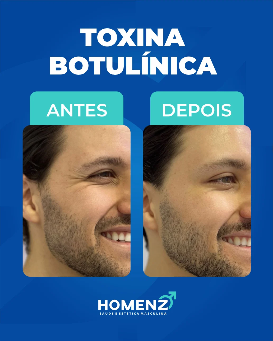 Antes e depois tratamento facial